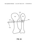 FIXATION AND ALIGNMENT DEVICE AND METHOD USED IN ORTHOPAEDIC SURGERY diagram and image