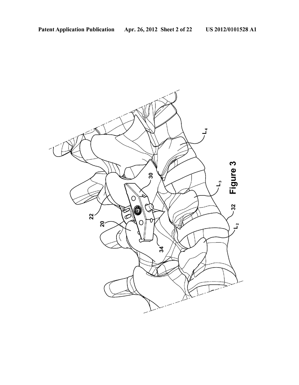 SPINOUS PROCESS IMPLANT AND METHOD OF FIXATION - diagram, schematic, and image 03