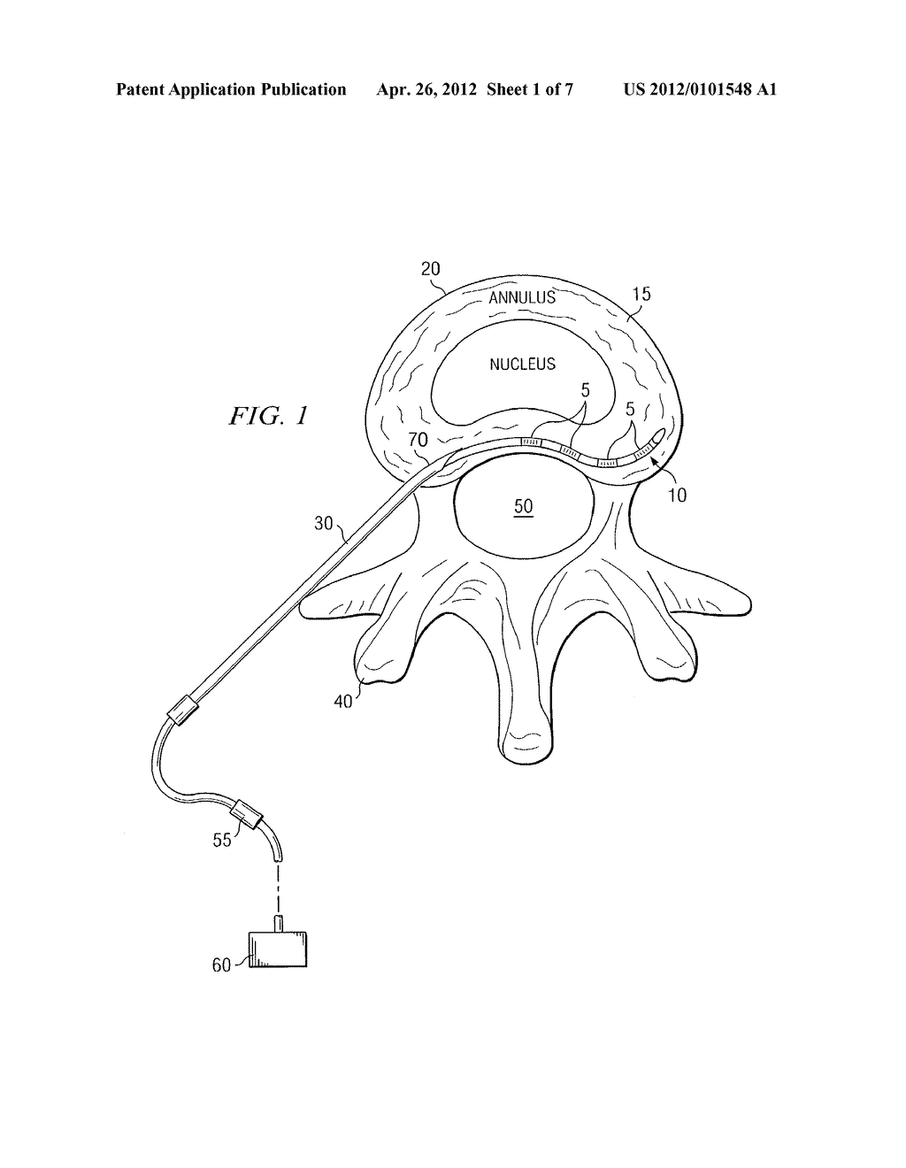 SYSTEM AND METHOD FOR ELECTRICAL STIMULATION OF THE INTERVERTEBRAL DISC - diagram, schematic, and image 02