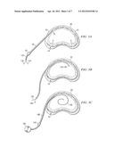 SYSTEM AND METHOD FOR ELECTRICAL STIMULATION OF THE INTERVERTEBRAL DISC diagram and image