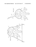 SYSTEM AND METHOD FOR ELECTRICAL STIMULATION OF THE INTERVERTEBRAL DISC diagram and image