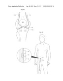 KNEE JOINT DEVICE AND METHOD diagram and image