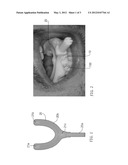 METHOD FOR PREPARING A SURGICAL MASK FOR THE INSTALLATION OF DENTAL     IMPLANTS diagram and image