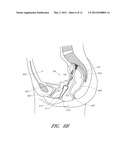 IMPLANT FOR PELVIC ORGAN PROLAPSE REPAIR diagram and image