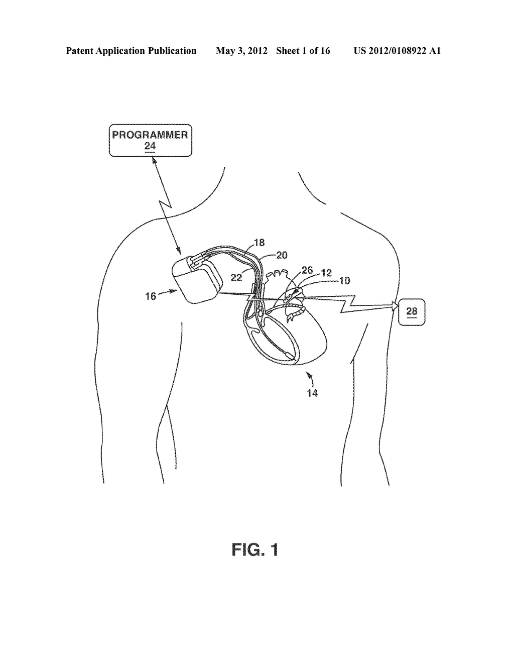 Implantable Medical Sensor and Fixation System - diagram, schematic, and image 02