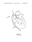 Steerable sheath access device diagram and image