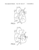 Steerable sheath access device diagram and image