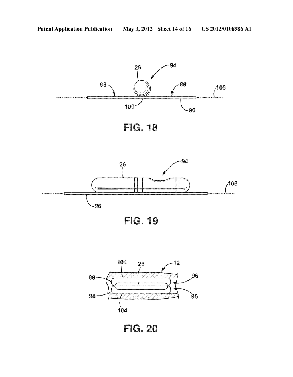 Implantable Medical Sensor and Fixation System - diagram, schematic, and image 15