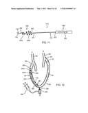 APPARATUS AND METHODS FOR TREATING OBSTRUCTIONS WITHIN BODY LUMENS diagram and image