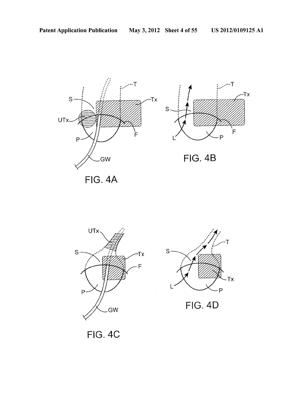 METHODS AND ELECTRODE APPARATUS TO ACHIEVE A CLOSURE OF A LAYERED TISSUE     DEFECT - diagram, schematic, and image 05