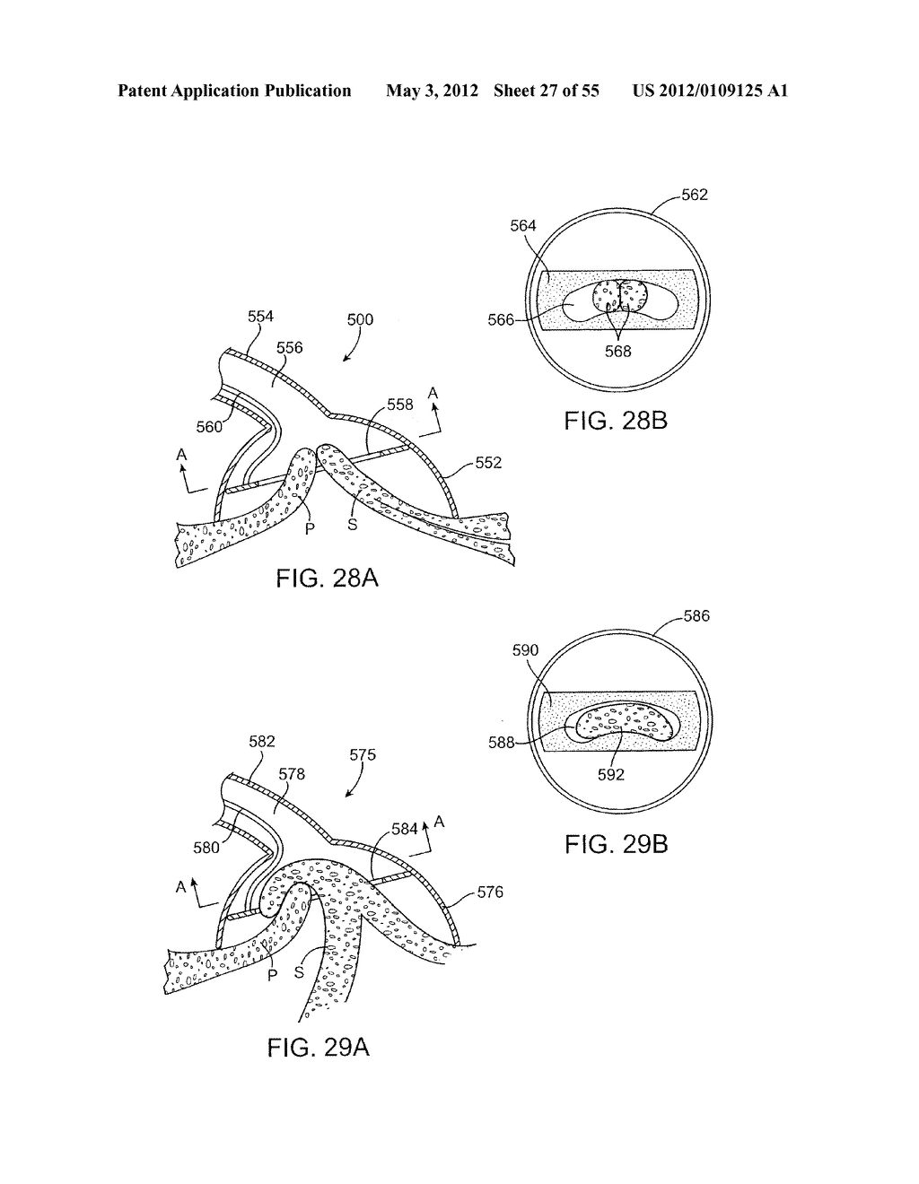 METHODS AND ELECTRODE APPARATUS TO ACHIEVE A CLOSURE OF A LAYERED TISSUE     DEFECT - diagram, schematic, and image 28