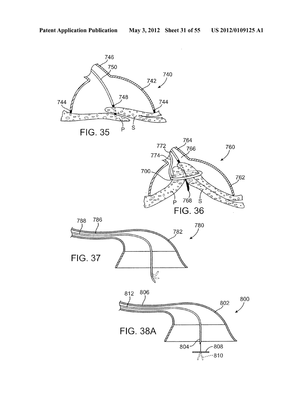 METHODS AND ELECTRODE APPARATUS TO ACHIEVE A CLOSURE OF A LAYERED TISSUE     DEFECT - diagram, schematic, and image 32
