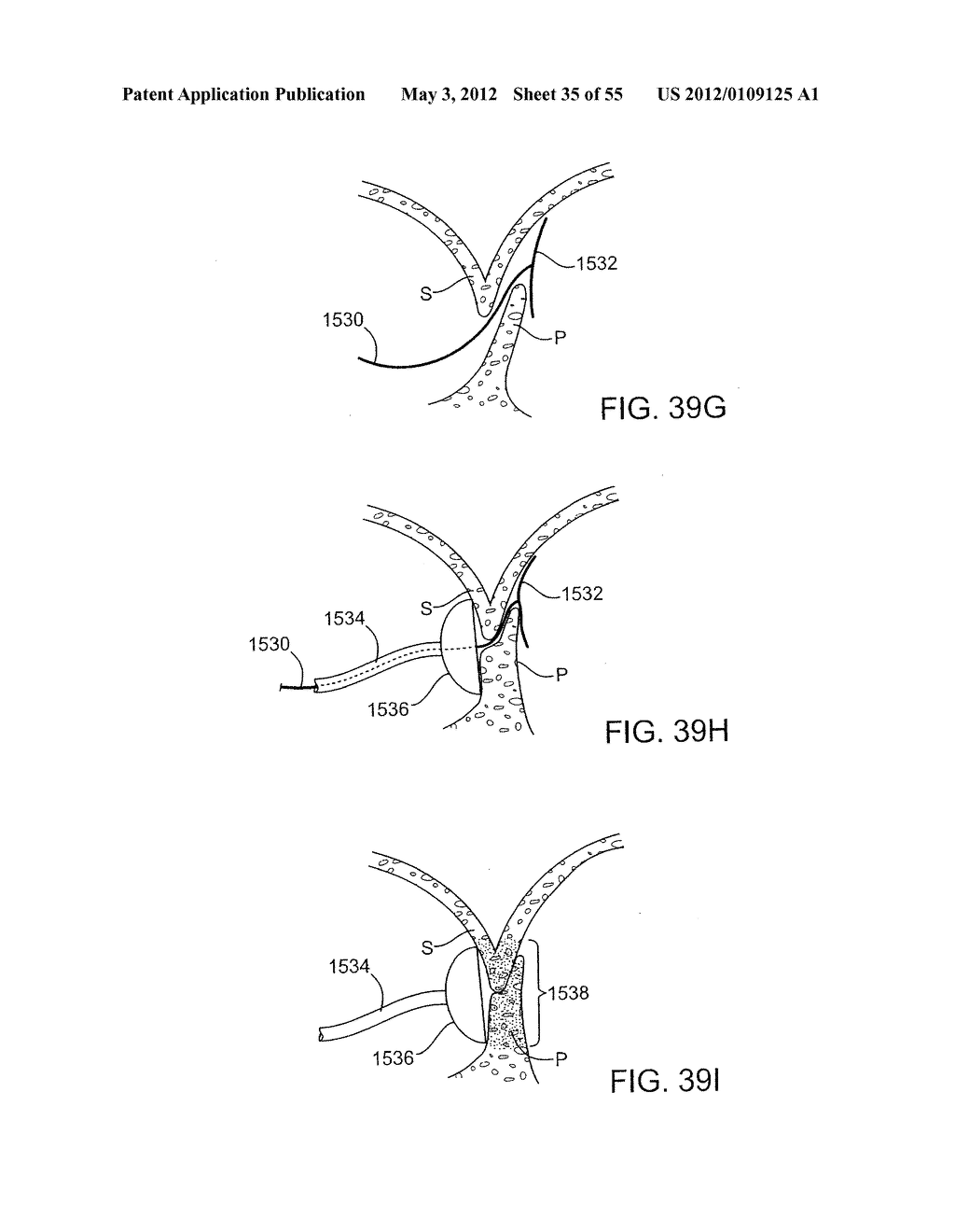 METHODS AND ELECTRODE APPARATUS TO ACHIEVE A CLOSURE OF A LAYERED TISSUE     DEFECT - diagram, schematic, and image 36