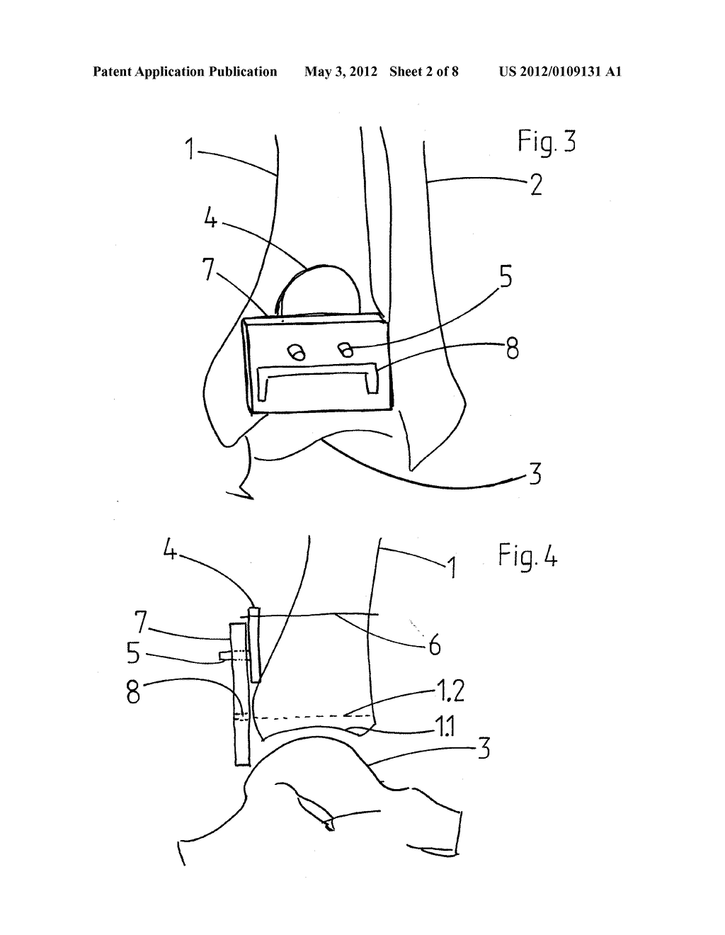 DEVICE FOR IN SITU MILLING OF JOINT SURFACES - diagram, schematic, and image 03