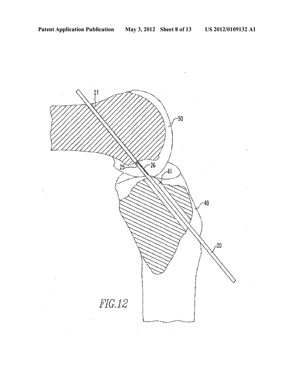 Device And Method For Use During Ligament Reconstruction - diagram, schematic, and image 09