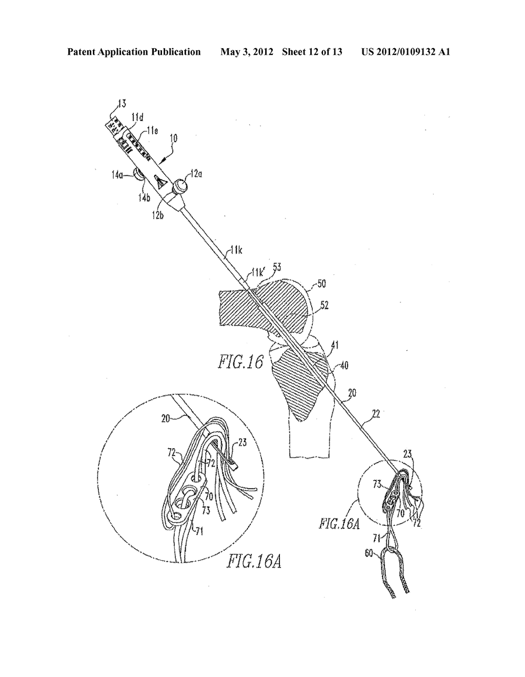 Device And Method For Use During Ligament Reconstruction - diagram, schematic, and image 13