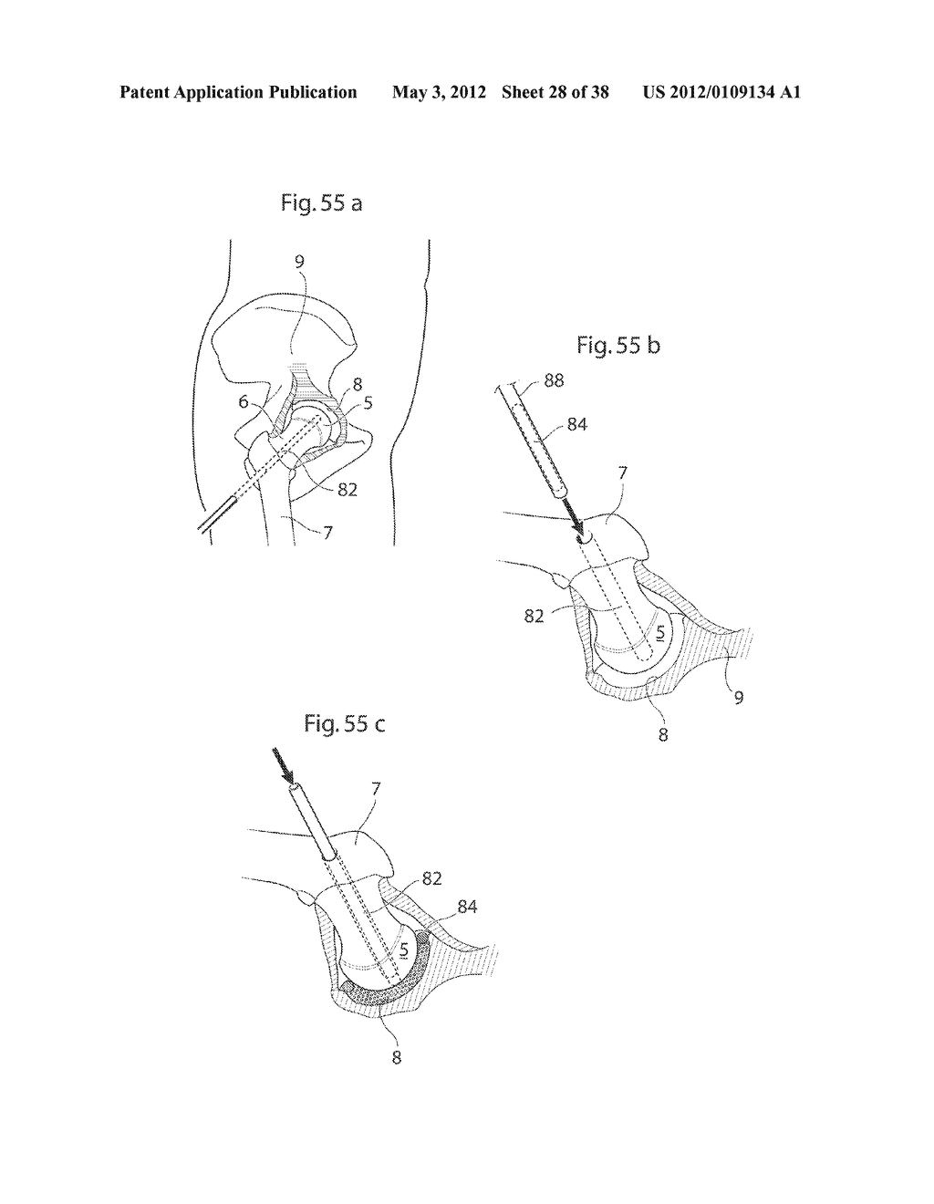 HIP JOINT INSTRUMENT AND METHOD - diagram, schematic, and image 29