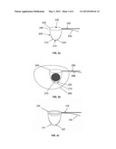 Systems and Methods for Tissue or Organ Removal diagram and image