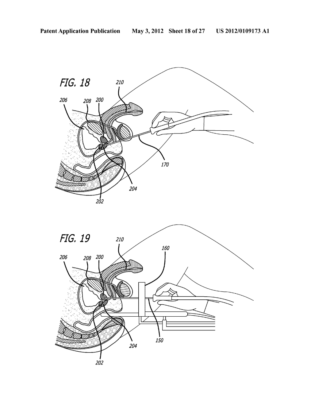 SYSTEM FOR TREATING THE PROSTATE - diagram, schematic, and image 19