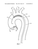 EMBOLIC PROTECTION DEVICE diagram and image