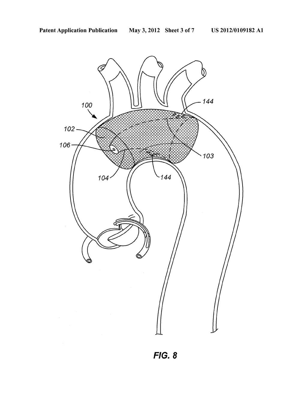 EMBOLIC PROTECTION DEVICE - diagram, schematic, and image 04
