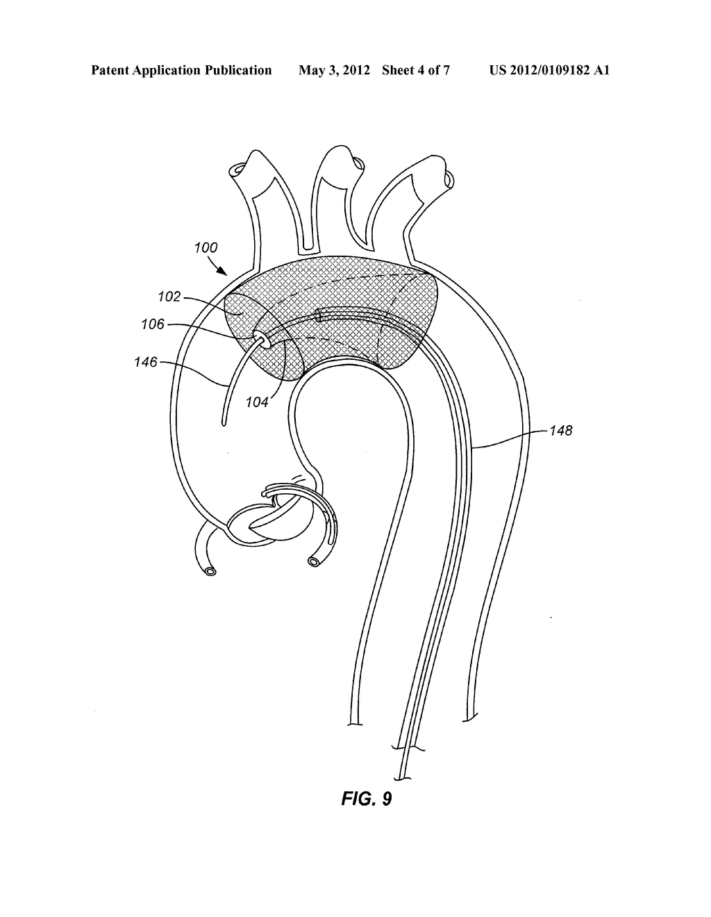 EMBOLIC PROTECTION DEVICE - diagram, schematic, and image 05