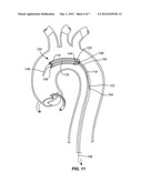 EMBOLIC PROTECTION DEVICE diagram and image