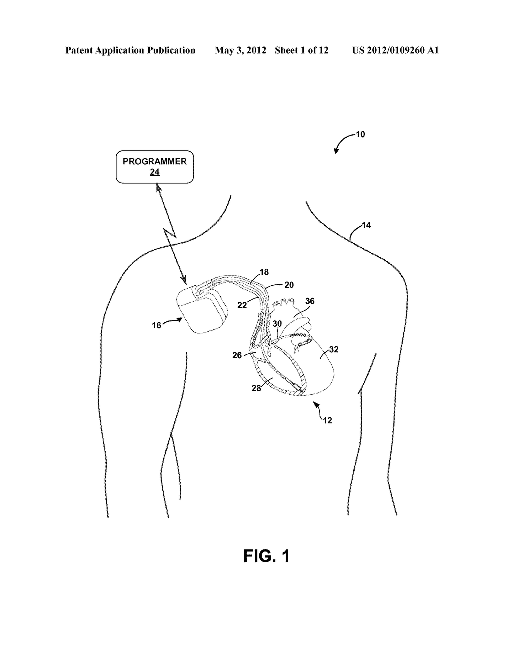 IMPLANTABLE MEDICAL DEVICE TELEMETRY IN DISRUPTIVE ENERGY FIELD - diagram, schematic, and image 02