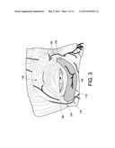 INFRA-ORBITAL IMPLANT diagram and image