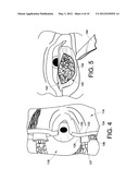 INFRA-ORBITAL IMPLANT diagram and image