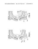 INFRA-ORBITAL IMPLANT diagram and image