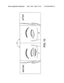 INFRA-ORBITAL IMPLANT diagram and image