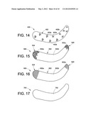 INFRA-ORBITAL IMPLANT diagram and image