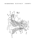 UNIVERSAL IMPLANT diagram and image