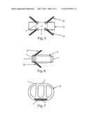 Intervertebral Implant diagram and image