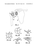 Modular Humeral Head Resurfacing System diagram and image