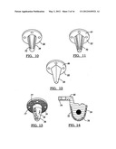 Modular Humeral Head Resurfacing System diagram and image