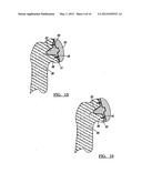 Modular Humeral Head Resurfacing System diagram and image