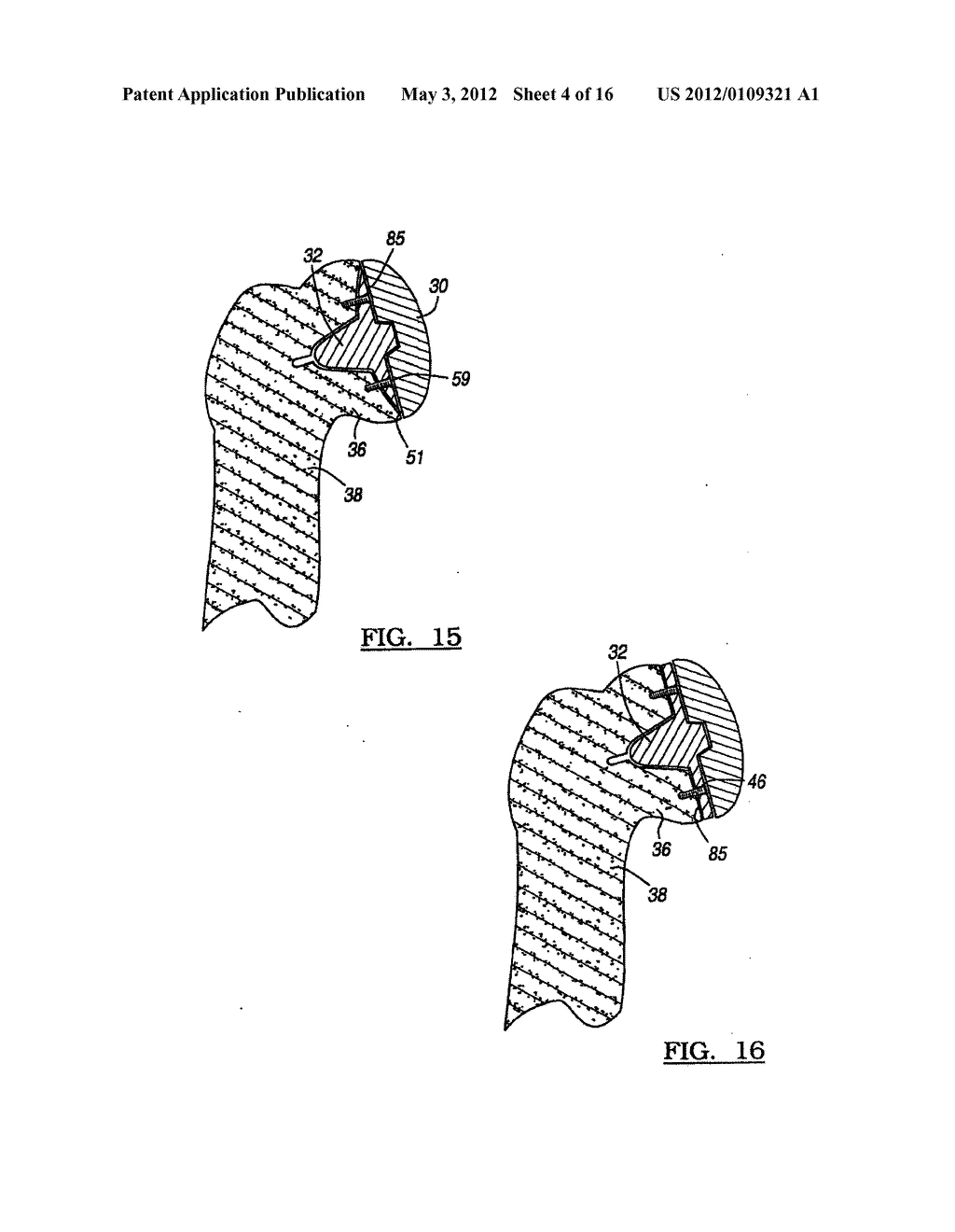 Modular Humeral Head Resurfacing System - diagram, schematic, and image 05