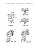 Modular Humeral Head Resurfacing System diagram and image