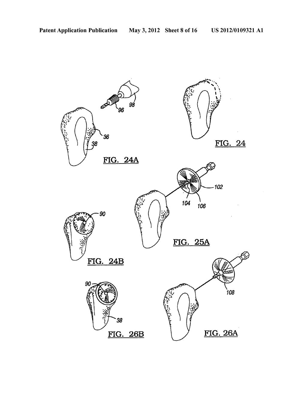 Modular Humeral Head Resurfacing System - diagram, schematic, and image 09