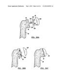 Modular Humeral Head Resurfacing System diagram and image