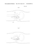 HIP JOINT DEVICE, SYSTEM AND METHOD diagram and image