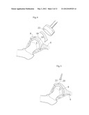 HIP JOINT DEVICE, SYSTEM AND METHOD diagram and image