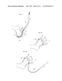 HIP JOINT DEVICE, SYSTEM AND METHOD diagram and image