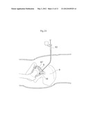 HIP JOINT DEVICE, SYSTEM AND METHOD diagram and image