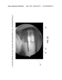 METHOD AND APPARATUS FOR RESTORING ARTICULAR CARTILAGE diagram and image