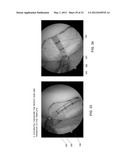 METHOD AND APPARATUS FOR RESTORING ARTICULAR CARTILAGE diagram and image