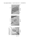 METHOD AND APPARATUS FOR RESTORING ARTICULAR CARTILAGE diagram and image