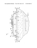 REDUCED-PRESSURE, COMPRESSION SYSTEMS AND APPARATUSES FOR USE ON BREAST     TISSUE diagram and image